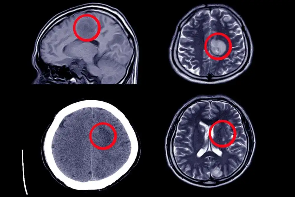 How We Treat Subarachnoid Hemorrhage